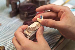 インプラントに磁性アタッチメントを活用